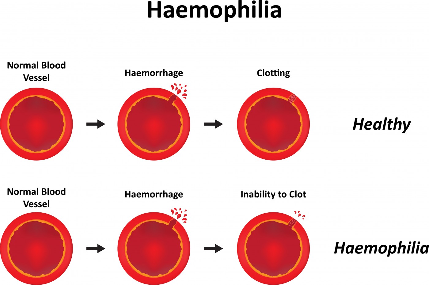 What Is Hemophilia? Definition, Symptoms of Hemophilia A and B